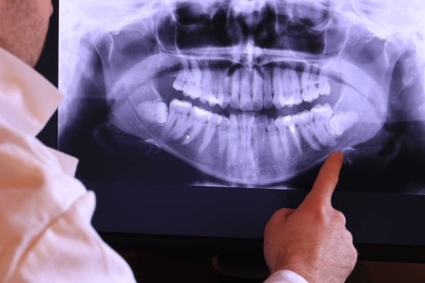 Best Emergency Wisdom Teeth Removal in Smithfield, NC