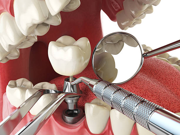 Best Emergency Dental Care for Broken or Chipped Teeth in Smithfield, NC